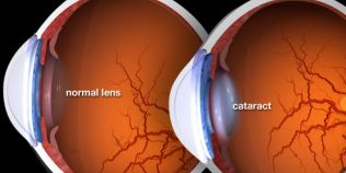 Cataracta poate aparea indiferent de varsta. Cu cat boala e mai evoluata, cu atat operatia e mai dificila